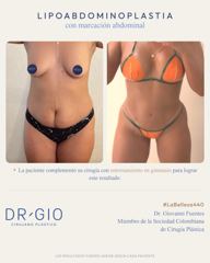 Lipoabdominoplasty with etching (complemented with gym training)