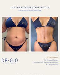 Lipoabdominoplasty with abdominal etching