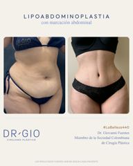 Lipoabdominoplasty with abdominal etching