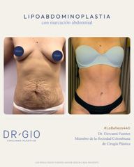 Lipoabdominoplasty with abdominal etching