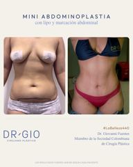 Mini tummy tuck with lipo and abdominal etching
